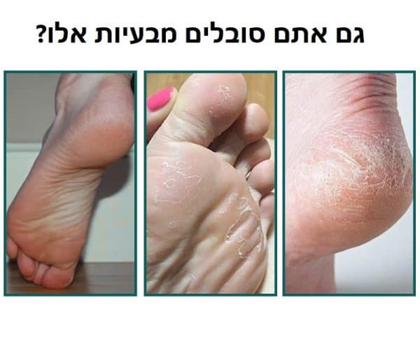 פילינג לכף הרגל לבעיות בעור